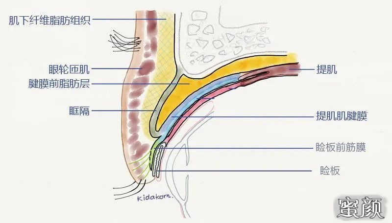 眼修复丨过宽重睑的修复双眼皮宽改窄怎么做