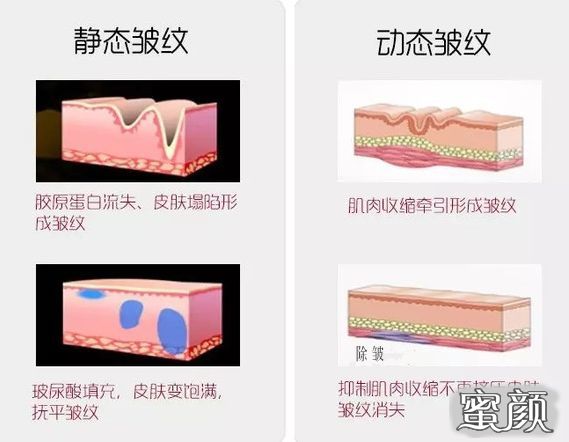 眶周轻颜 人未老 眼先衰 如何打破眶周魔 皱 蜜颜整形优惠