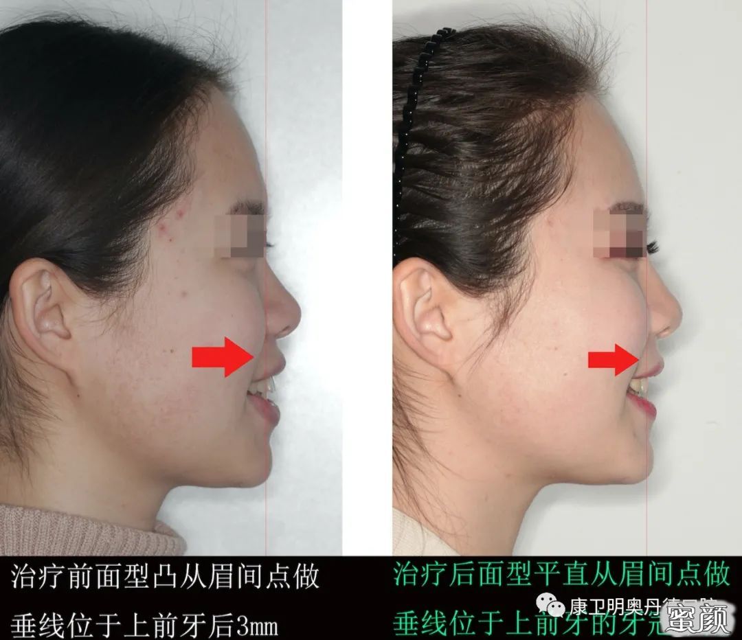 为什么矫治牙齿的孩子和成人越来越多 蜜颜整形优惠