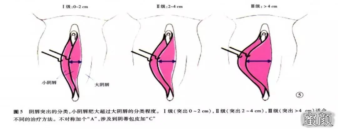 出现这几点 你就需要做阴唇手术了 蜜颜整形优惠