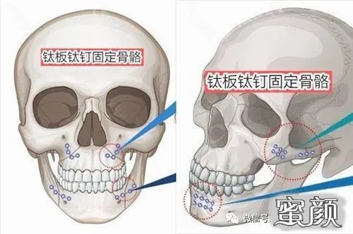 颧骨手术后钛钉不取有没有后遗症用可溶性的材料固定效果如何