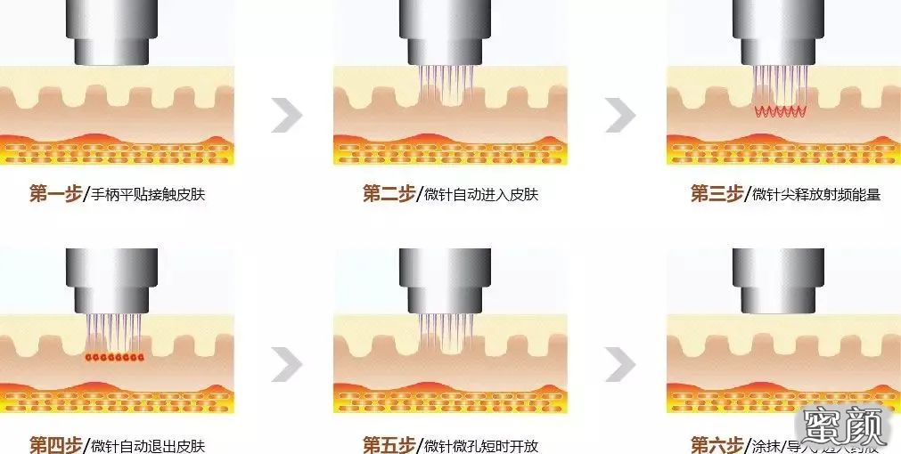 一直被低估的黄金微针让重返皮肤的黄金时代