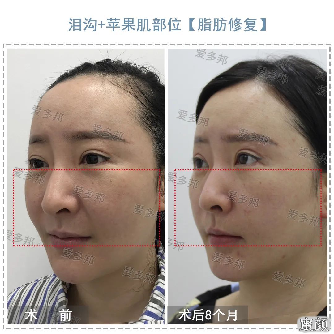面部脂肪填充案例，术后半年恢复效果记录。-蜜颜优惠