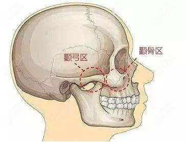 颧骨内推磨骨削骨哪个伤害低一点想找风险小的