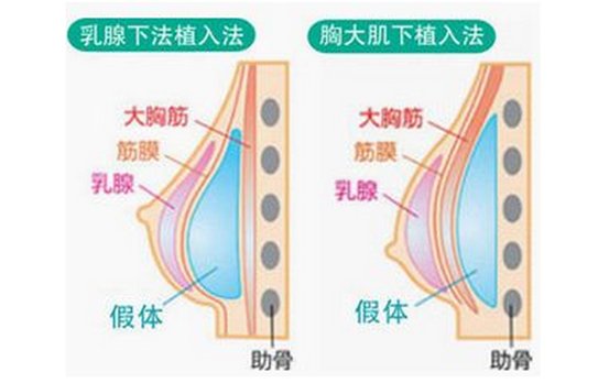 假体隆胸3d演示过程图片