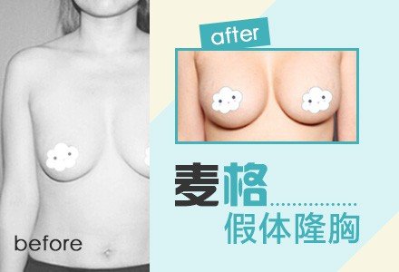 重庆美国麦格假体隆胸-