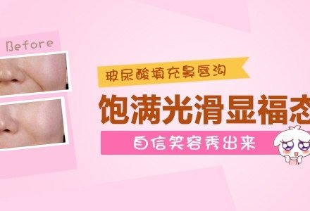 上海玻尿酸注射鼻唇沟-