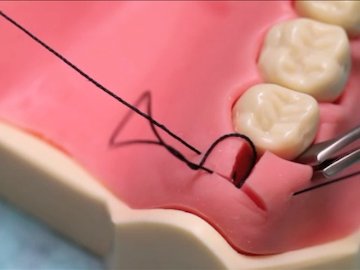 continuous sling suture 连续悬吊缝合14.