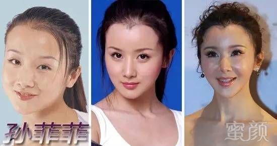 隆鼻整容_整容隆鼻要多少钱呢_隆鼻整容手术