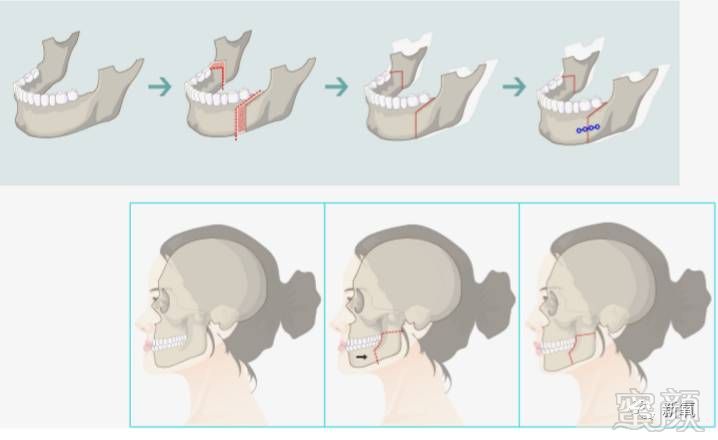 地包天的正颌手术,如果是正畸来改善地包天的话,就是正常的戴牙套