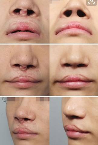 按照唇裂的程度又可以划分等级,不同唇裂表现和症状采取的手术方法都