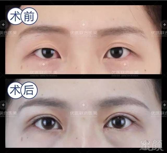 做双眼皮之前 一定要先了解这些 蜜颜整形优惠